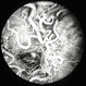 Retinal AV malformation FA 2